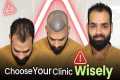 Hair Transplant in Surat (HX-IQPO) |
