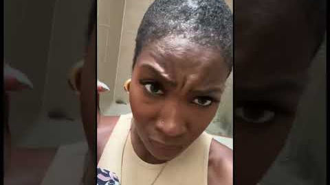 Hair transplant 6 month update short