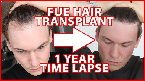 FUE Hair Transplant Timeline 1 YEAR | day 1-365 | 12 Months Progress Before and After