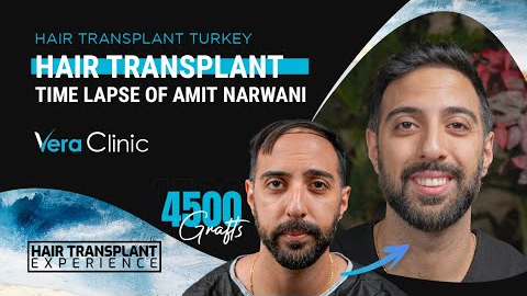 1 Year of Hair Transplant Results Time Lapse in Turkey #hairtransplant #hairtransplantturkey