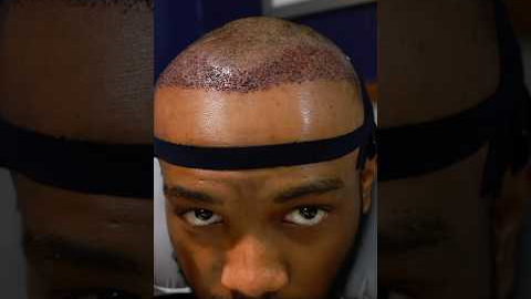 1 Year Hair Transplant Update👨🏾‍🦲‼️