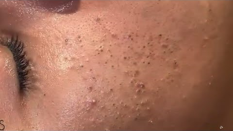 asmr deep cleansing facial blackhead extraction & relaxing skin care