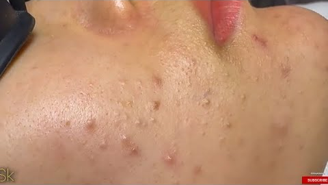 Satisfying [ASMR] Facial Routine for Acne-Free Skin & Blackhead Removal