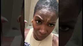 Hair transplant 6 month update short