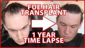 FUE Hair Transplant Timeline 1 YEAR | day 1-365 | 12 Months Progress Before and After