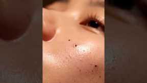 “Deep Pore Vacuum Cleaning ASMR | Intense Blackhead Suction Sounds”