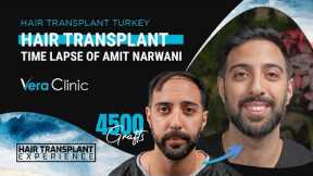 1 Year of Hair Transplant Results Time Lapse in Turkey #hairtransplant #hairtransplantturkey