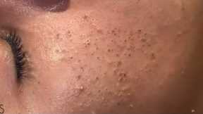 asmr deep cleansing facial blackhead extraction & relaxing skin care