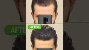 My insane hair regrowth journey (Time-Lapse)