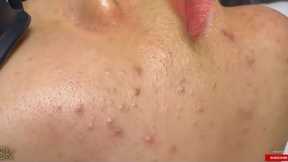 Satisfying [ASMR] Facial Routine for Acne-Free Skin & Blackhead Removal