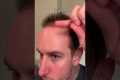 3-Month Hair Transplant Progress,