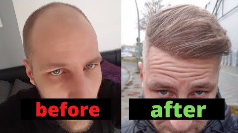 From Day 0 to Month 12 - Hair Transplant Turkey Comparison