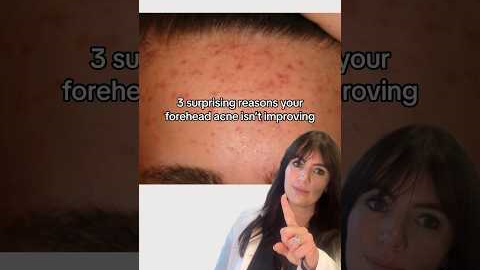 4 reasons why your forehead acne isn’t improving👆🏽 #acne #acnehelp #acneproneskin #acnetreatment