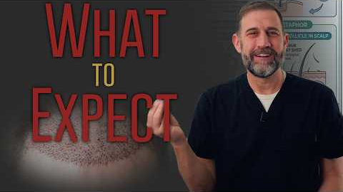 Your Hair Transplant Results Month by Month — The Full 12-Month Timeline