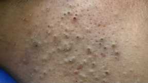 [ASMR] Ultimate Pimple Treatment: Korean Skincare Routine for Acne-Prone Skin & Blackheads
