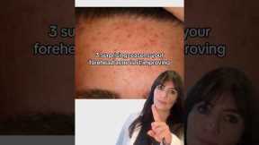 4 reasons why your forehead acne isn’t improving👆🏽 #acne #acnehelp #acneproneskin #acnetreatment