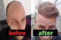 From Day 0 to Month 12 - Hair