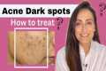 Acne Dark Spots | हिंदी | How to