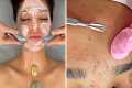 ACNE NO Talking SPA-ASMR Facial