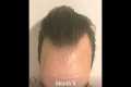 Daily Time Lapse of Hair Growth after 