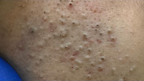 [ASMR] Facial Care Routine for Pimple and Blackheads Removal, Satisfying Skincare
