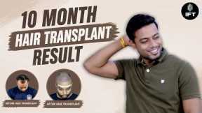 Hair Transplant in Jaipur | Trusted Clinic & Cost of Hair Transplant in Jaipur